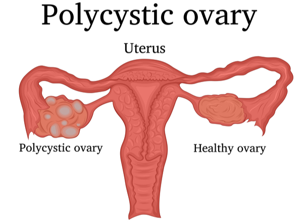Σύνδρομο των πολυκυστικών ωοθηκών