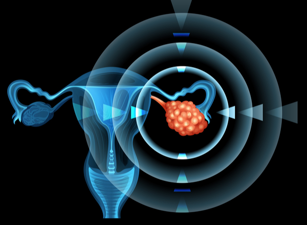 Καρκίνος του τραχήλου της μήτρας: Νεότερα δεδομένα στον έλεγχο των γυναικών