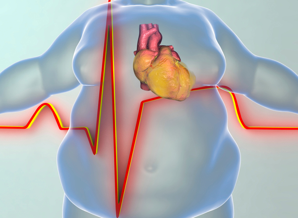 Καρδιαγγειακά νοσήματα στην παχυσαρκία