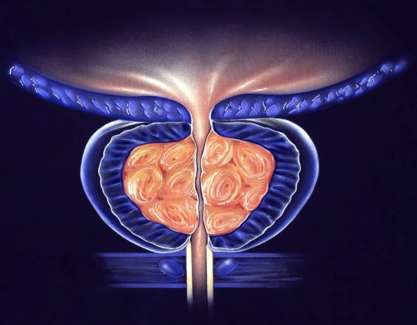 Υπερπλασία προστάτου:  διάγνωση & θεραπεία