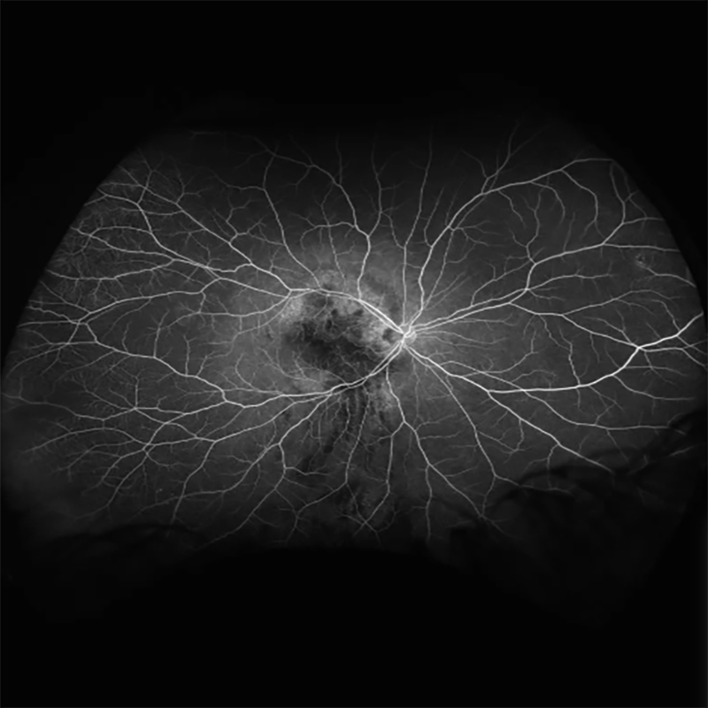 OPTOS SILVERSTONE SS OCT FLUORESCEIN ANGIOGRAPHY